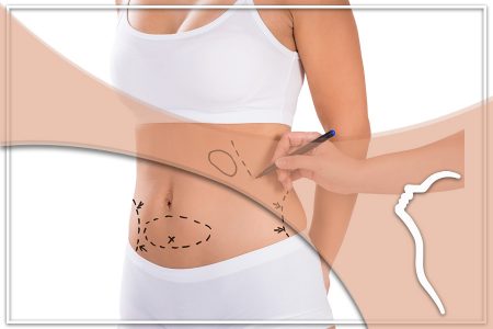 liposuction liposuction